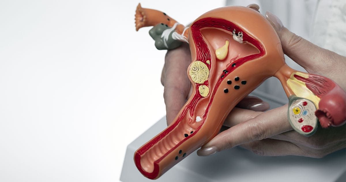 Endometriosi